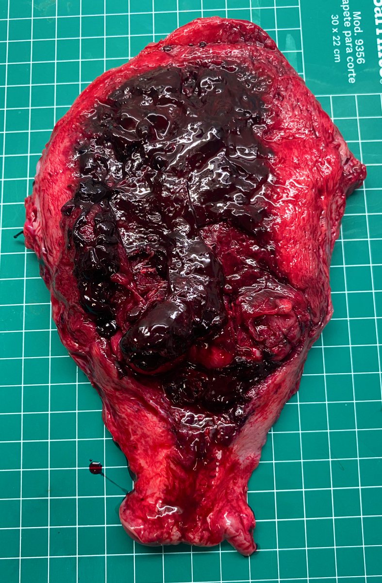dianapath1's tweet photo. The unexpected Placental Accretism Spectrum, we always have to look for it #grossognosis #macroscopy #pathology #ObstetricPathology #Macroscopia #pathologist #PathTwitter https://t.co/1dPdZFETvv