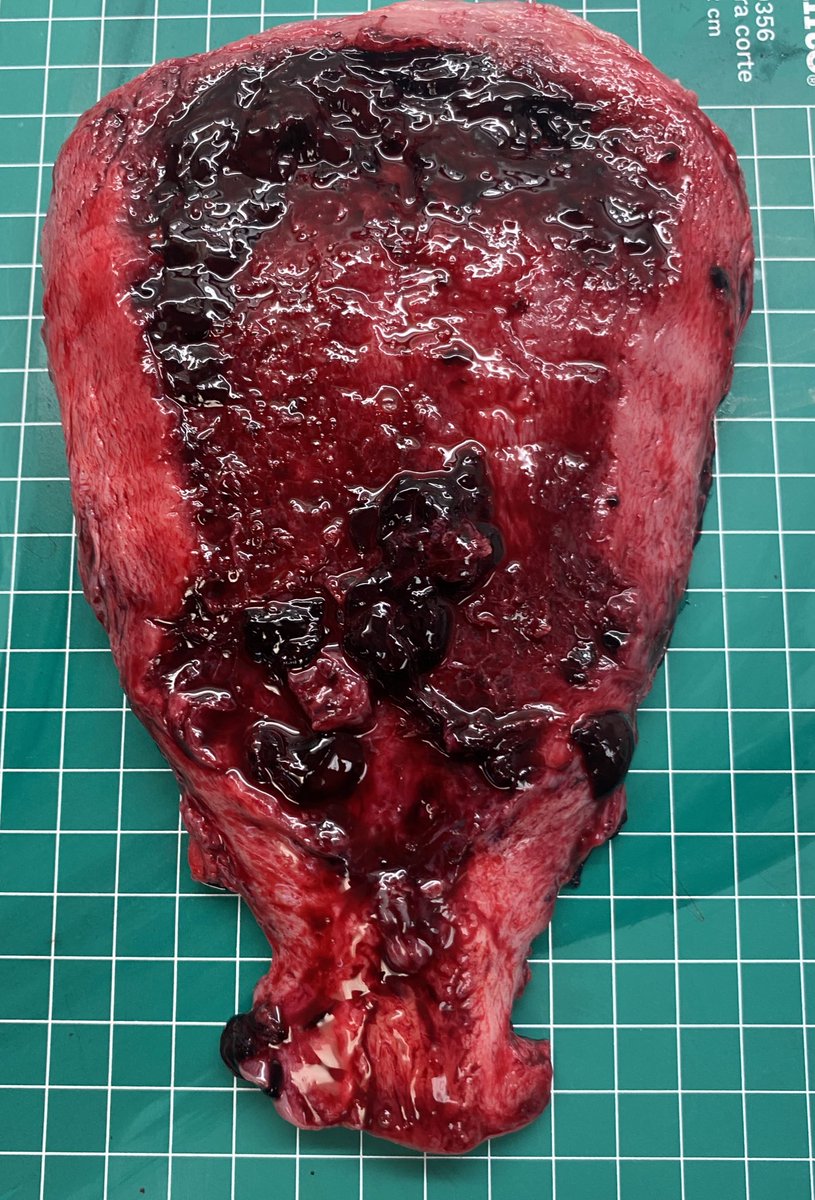 dianapath1's tweet photo. The unexpected Placental Accretism Spectrum, we always have to look for it #grossognosis #macroscopy #pathology #ObstetricPathology #Macroscopia #pathologist #PathTwitter https://t.co/1dPdZFETvv