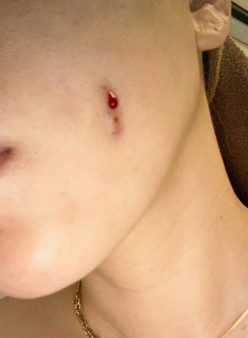 lovexpeace0101's tweet photo. 美容整形の被害防止のためリポスト、拡散お願いします

ヴェリテでえくぼ形成を失敗された患者の症例。担当医からの話では簡単な手術という説明であったが、口内から貫通していまいしばらく出血が止まらなかったとのこと。この状態になってはレーザー治療などを施しても完全には消せないだろう。 https://t.co/1EbNZJxlam