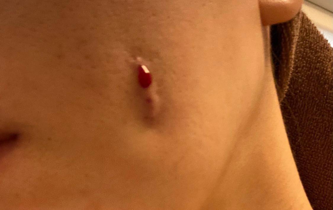 lovexpeace0101's tweet photo. 美容整形の被害防止のためリポスト、拡散お願いします

ヴェリテでえくぼ形成を失敗された患者の症例。担当医からの話では簡単な手術という説明であったが、口内から貫通していまいしばらく出血が止まらなかったとのこと。この状態になってはレーザー治療などを施しても完全には消せないだろう。 https://t.co/1EbNZJxlam