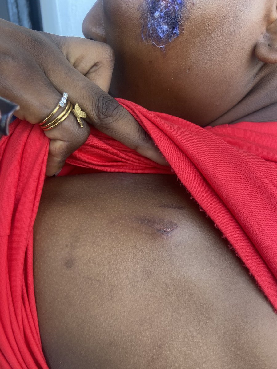 Ayomiepat_'s tweet image. Urgent plea: This girl is facing physical abuse from her brother. She&apos;s in dire need of help. This happened because she refused to live in the apartment their father rented for them. Her reason for not wanting to live with him is his violent behavior which is valid.