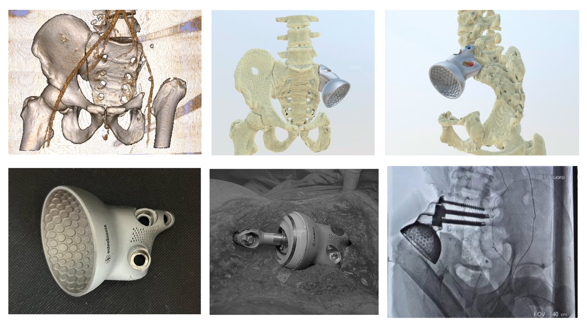 POC fabrication of a 𝗰𝘂𝘀𝘁𝗼𝗺-𝗺𝗮𝗱𝗲 𝗶𝗺𝗽𝗹𝗮𝗻𝘁 (IIb) for pelvic reconstruction after partial resection of the iliac bone affected by Ewing's sarcoma. Collaboration between UPAM3D engineers and CSUR Sarcoma Unit surgeons 
#UPAM3D #HospitalGregorioMarañon #impresion3D
