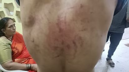 Mrsinha's tweet photo. This is how a Tilak wearing Hindu boy Sachin is beaten by MusIim mobs for sitting with a MusIim girl in INC ruled Karnataka. They locked him up in a room &amp; lashed him out for 3 hours.

Imagine the amount of outrage if he was a MusIim boy, beaten by Hindus in a BJP ruled state. https://t.co/lVKgERcAnP