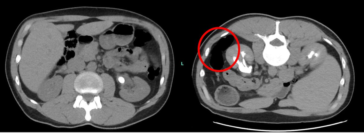 Zoltán Kiss (@zoltankissdr) on Twitter photo CT scan in the same patient in supine and prone position.Retrorenal colon on prone.If we plan #PCNL, should we perform the CT scan in the same position?@GoumasUrologia <a href="/mzawadzk1/">Marek Zawadzki</a> <a href="/oangerri/">Oriol Angerri</a> @uropatrick <a href="/vdconinck/">Vincent De Coninck</a> <a href="/StefaniaFerret/">Stefania Ferretti</a> <a href="/kpetik1/">Peter Kovacs, MD, FEBU</a> <a href="/OJWiseman/">Oliver Wiseman</a> CT scan in the same patient in supine and prone position.Retrorenal colon on prone.If we plan #PCNL, should we perform the CT scan in the same position?@GoumasUrologia <a href="/mzawadzk1/">Marek Zawadzki</a> <a href="/oangerri/">Oriol Angerri</a> @uropatrick <a href="/vdconinck/">Vincent De Coninck</a> <a href="/StefaniaFerret/">Stefania Ferretti</a> <a href="/kpetik1/">Peter Kovacs, MD, FEBU</a> <a href="/OJWiseman/">Oliver Wiseman</a>