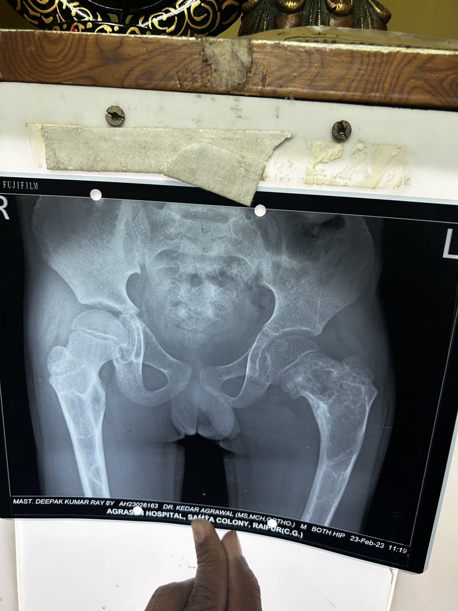 OrthoDoctor_GSP's tweet photo. Fibrous dysplasia #Orthotwitter #Orthodox #Orthodoctor #Orthoman #Pediatricortho https://t.co/8kAsSwYIVk