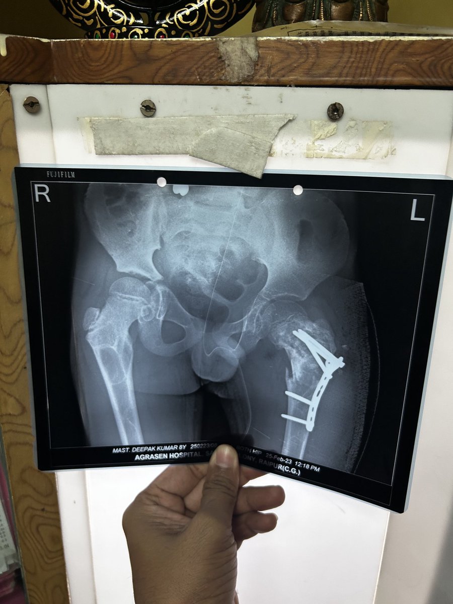 OrthoDoctor_GSP's tweet photo. Fibrous dysplasia #Orthotwitter #Orthodox #Orthodoctor #Orthoman #Pediatricortho https://t.co/8kAsSwYIVk