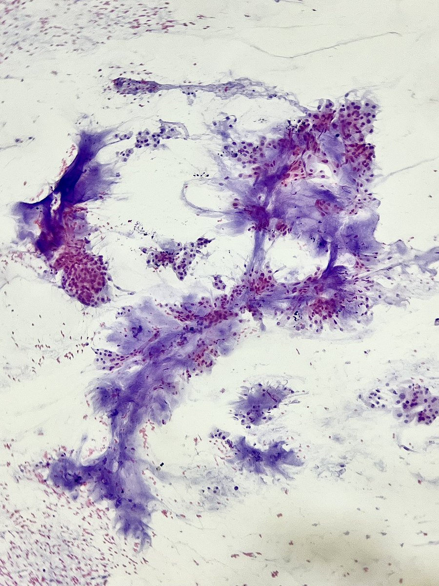 ‘One is never in the wrong place. Sometimes we are in the right place looking at things the wrong way’

40s/M - Neck mass 

#Cytopath #headneckpath #impath #pathout #ENTpath