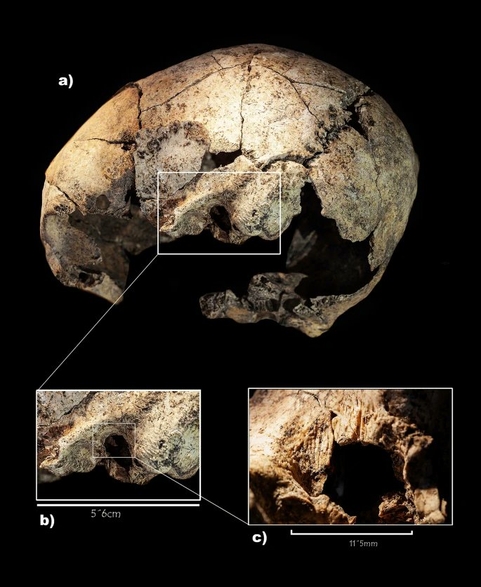 The earliest known ear surgery was found in Spain by a team from the University of Valladolid. This 5,000-year-old skull shows signs of a mastoidectomy, a procedure to ease pain from the inflammation in the middle ear or adjacent bone.
#FunFactFriday #MedicalHistory @SoniaDiazNv
