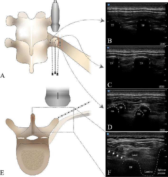 RAPMOnline's tweet photo. 🩺✨ Exploring Intertransverse Process Blocks: Single vs. Multiple Injections 📊👥

The study delves into the effectiveness of single versus multiple injections in intertransverse process blocks for postoperative pain relief after thoracic surgeries.

https://t.co/UwkMPc6EFO https://t.co/ecErHhbAkE