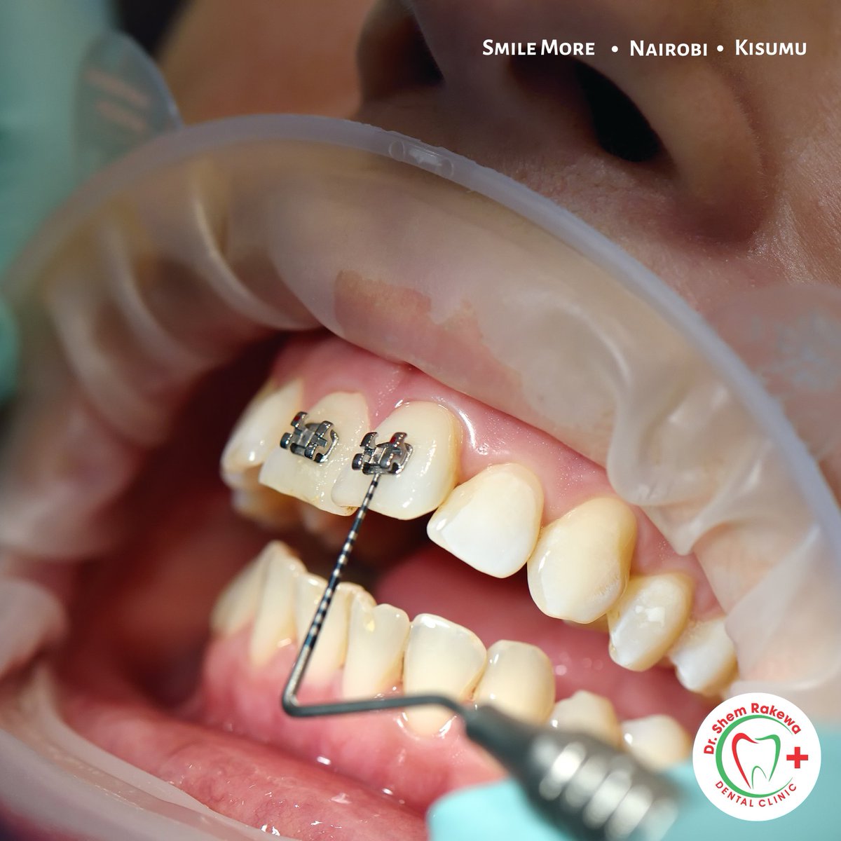 DrShemRakewa's tweet image. Braces work slowly but the results are natural 😁 experience professional and personalized orthodontic care at our clinic. 

#braces #orthodontics #teethalignment #drshemdentalclinic #bracesinnairobi #orthodonticske