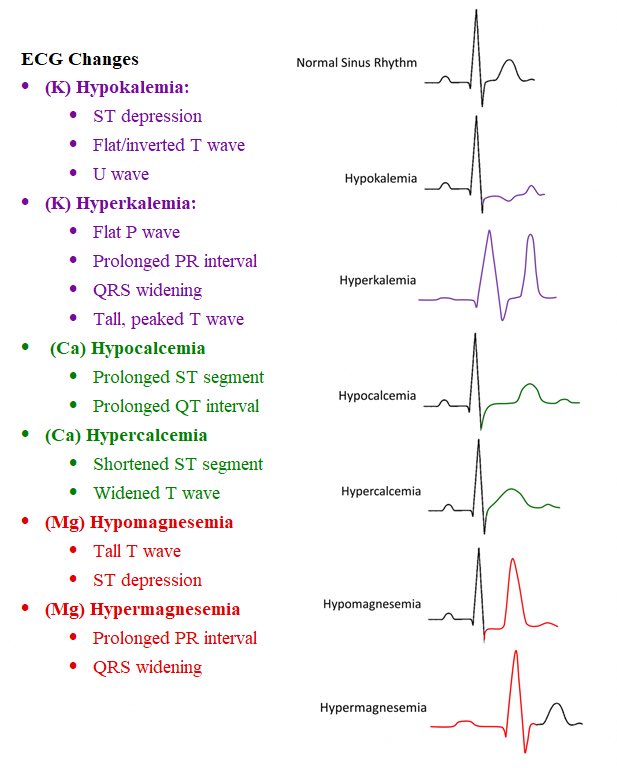 emergencyclub1's tweet photo. @ManualOMedicine ECG Changes in electrolyte imbalance https://t.co/pHqk8E08iv