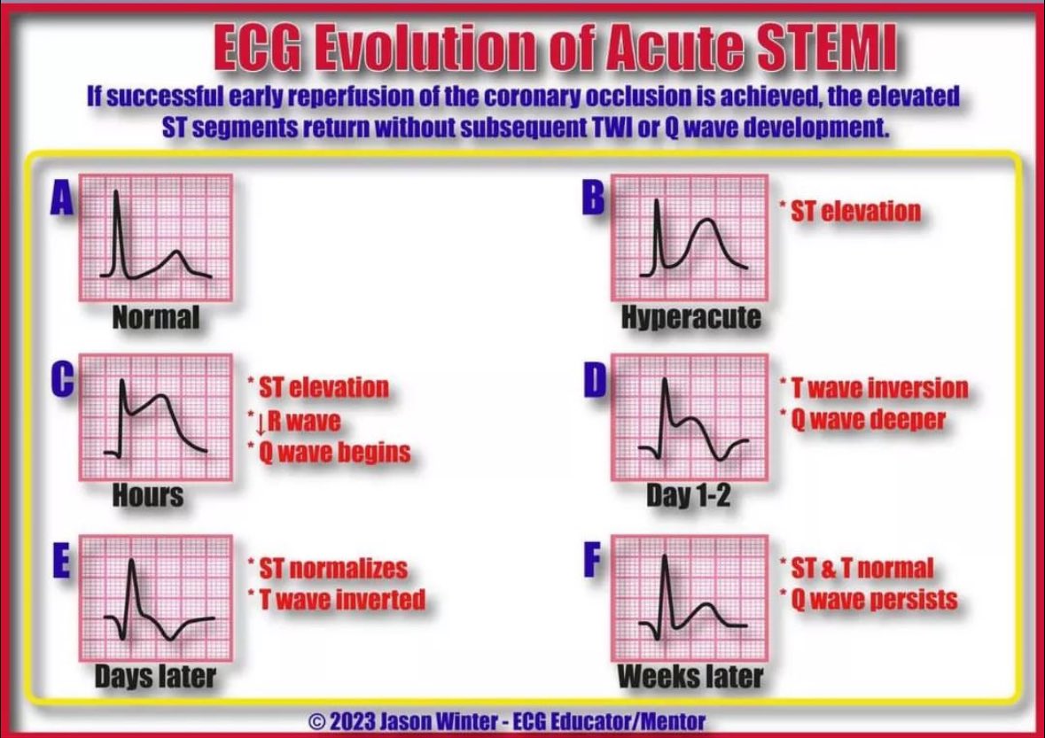 asmar097's tweet photo. STEMI🧐 https://t.co/6cQD0gxNI3