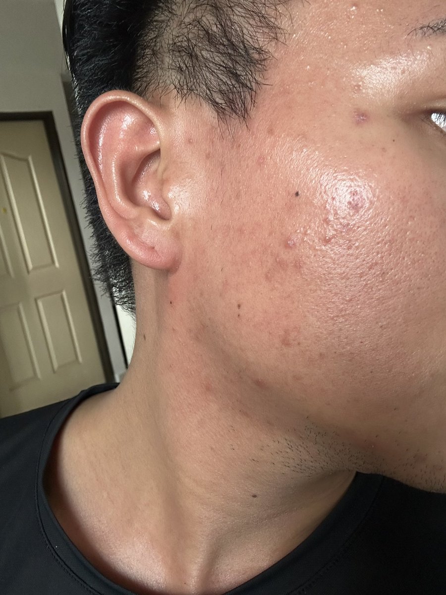 JsQuinlan29's tweet photo. PART 1

I'm not single!
Sy ada on-off relationship with acne🥲🥰

Lemme share drpd bnyk2 products yang sy prnh try... These r some yng berkesan for me (ni my opinion n experience ya)😌 https://t.co/DPV66iblbQ