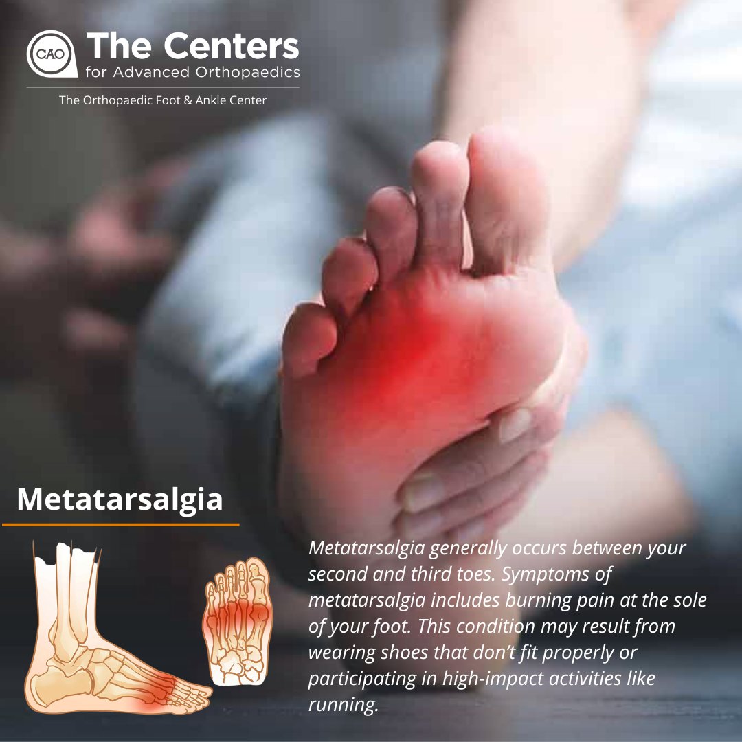 Metatarsalgia 🦶Learn more about this common foot condition and how to find relief by visiting footankledc.com 🦶

#metatarsalgia #footpain #FootPainRelief #podiatry #orthopedics #northernvirginia