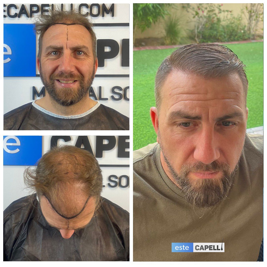 Best Hair Transplant in Turkey | EsteCapelli

Contact EsteCapelli Now for More information 👇👇👇
📲 +90 541 541 00 41
📩 info@estecapelli.com

#estecapelli  #estecapelliclinic  #hair  #hairtransplant  #hairtransplantistanbul  #hairsurgery  #hairtransplantbeforeafter #hairtrans