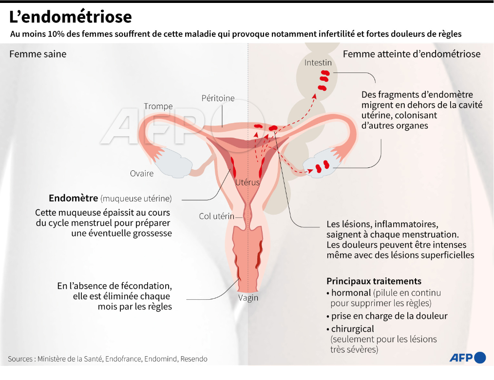 afpfr's tweet image. La Haute autorité de santé a proposé que certaines femmes puissent avoir accès à un test salivaire visant à diagnostiquer l'endométriose. Selon les premières études réalisées, sa précision diagnostique avoisine 95% #AFP