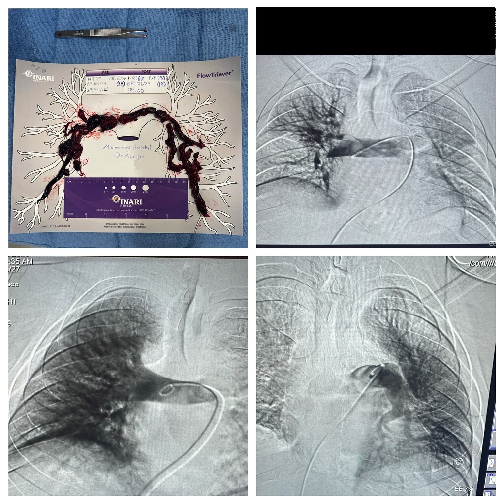 Amit Ramjit (@amitramjitmd) on Twitter photo Great case with <a href="/JohnDove01/">John Dove</a> - large clot haul w/<a href="/InariMedical/">Inari, now part of Stryker</a>, large drop in PA pressure post thrombectomy <a href="/MedDeviceMatt/">MP</a> <a href="/BC_Inari/">Brendan Carey</a> <a href="/McLean_Beyor/">McLean Beyor</a> <a href="/SIRspecialists/">Society of Interventional Radiology</a> <a href="/PERTConsortium/">The PERT Consortium®</a> <a href="/PertPoz/">PERT-POZ</a> Great case with <a href="/JohnDove01/">John Dove</a> - large clot haul w/<a href="/InariMedical/">Inari, now part of Stryker</a>, large drop in PA pressure post thrombectomy <a href="/MedDeviceMatt/">MP</a> <a href="/BC_Inari/">Brendan Carey</a> <a href="/McLean_Beyor/">McLean Beyor</a> <a href="/SIRspecialists/">Society of Interventional Radiology</a> <a href="/PERTConsortium/">The PERT Consortium®</a> <a href="/PertPoz/">PERT-POZ</a>