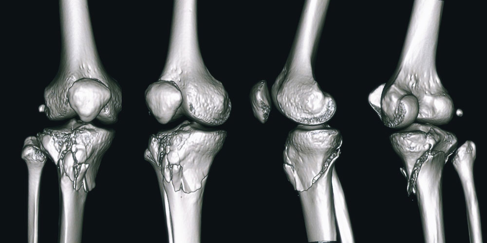 thekneedoc's tweet photo. What are the symptoms of a #tibialplateau f#racture?
· Pain when weight is applied
· Swelling
· Limited range of motion
· Severe cases – numbness or “pins and needles” in the foot due to nerve damage
https://t.co/uiV4bldiNi #sportsmedicine #orthotwitter #kneeexpert https://t.co/O5yf7yhHSz