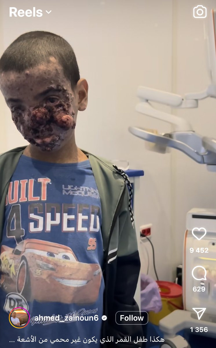 O_Rob1nson's tweet photo. This image of a child in hospital circulating on X has nothing to do with Israel.

The video was filmed in Morocco and posted by the founder of a local charity that helps children with XP - a rare genetic condition that causes extreme sensitivity to sunlight. https://t.co/BQ3hCxLyB4
