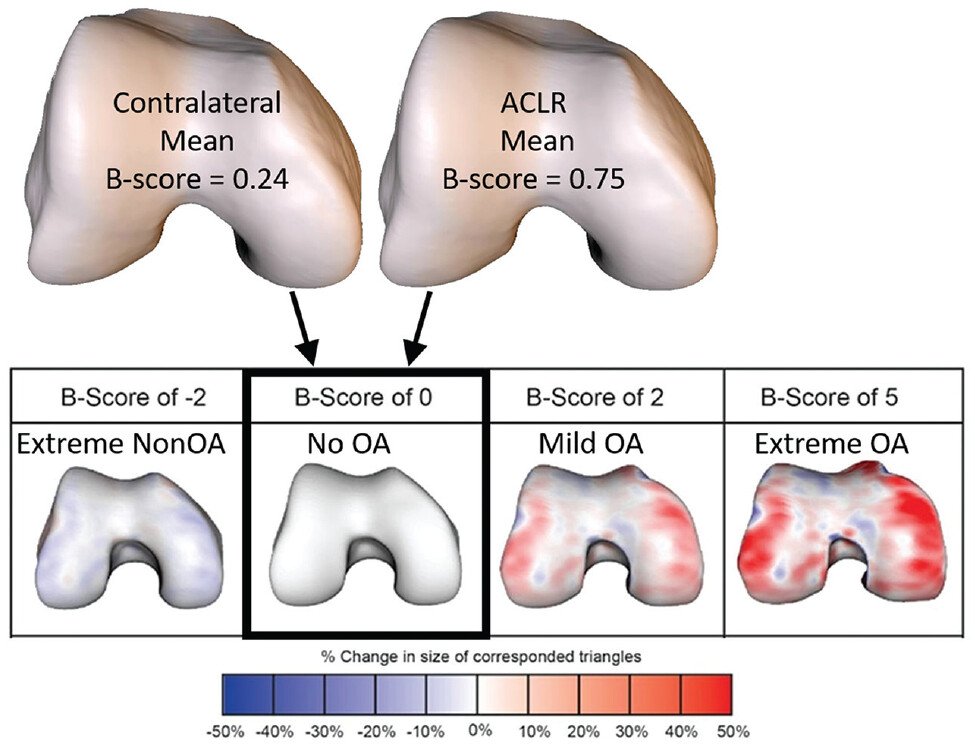 AOSSM Journals (@aossmjournals) on Twitter photo Shape matters after an ACL injury. Bilateral statistical bone shape modeling in patients just 2 years after #ACLR showed findings consistent with pre-OA in a study from <a href="/Stanford_Ortho/">Stanford Orthopaedics</a> Here more on the December 5-in-5 podcast
ow.ly/olxF50QoA9Y Shape matters after an ACL injury. Bilateral statistical bone shape modeling in patients just 2 years after #ACLR showed findings consistent with pre-OA in a study from <a href="/Stanford_Ortho/">Stanford Orthopaedics</a> Here more on the December 5-in-5 podcast
ow.ly/olxF50QoA9Y