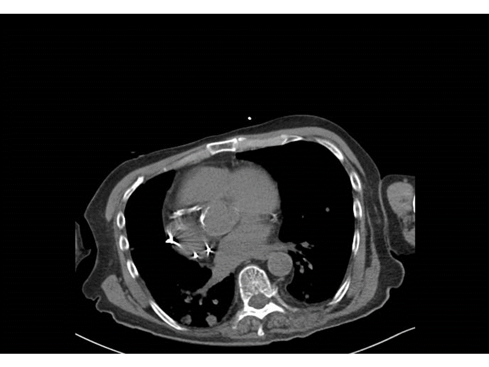 slusagar's tweet photo. #surgpath🧩time!
80ish M with h/o prostate cancer (normal serum PSA) presents with lung mass, biopsied
🤨🔬❓ https://t.co/s62oeb4Sa0