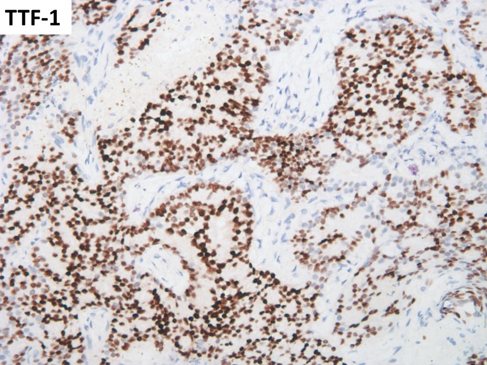 slusagar's tweet photo. #surgpath🧩time!
80ish M with h/o prostate cancer (normal serum PSA) presents with lung mass, biopsied
🤨🔬❓ https://t.co/s62oeb4Sa0