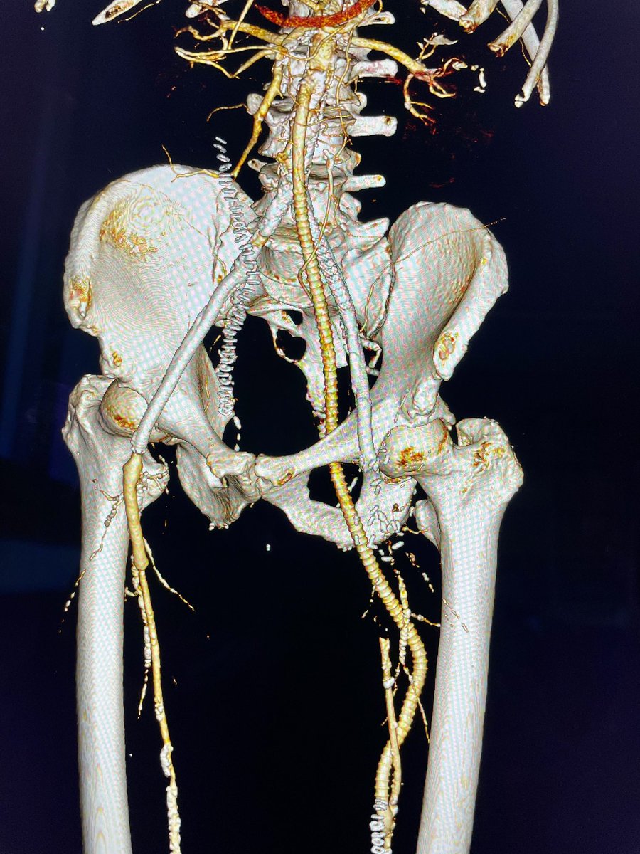 Obturator foramen bypass as extra-anatomic route for a redo redo infected groin #vascularsurgery