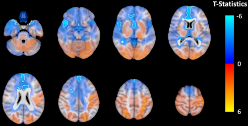 Treatment with #radiation and #chemotherapy affects the #brain in head and neck #cancer shown by #nuclear #neuroimaging. #neurology #radonc #radres #neurorad #oncology #otolaryngology #neurosurgery #neurotwitter #neuroscience onlinelibrary.wiley.com/doi/10.1111/jo…