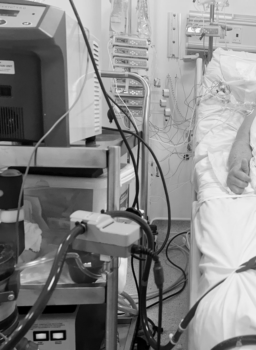 paomorejon's tweet photo. 🧔🏻♂️….
🗓️ Noviembre
STEMI (ATC fallida) en otro 🏥🔜CABG/MIDA (alta ok) #ClinicaGuayaquil
❤️🩹Fey 55%
🏠un mes en casa
🗓️ Enero 2024
🏥 #ShockCardiogenico SCAI-D 🔜#ECMO-VA
💔30%
⏰ a las 2 horas 🚨 Supra aVR #EKGfirst
🧘 CCG🔜oclusión de TCI🔜ATC por @FaustoHerediaDr
✅MIDA & #MCS lo salvaron👏🏻
Trabajo de cardiología crítica/intervencionista, cirujanos cardiovasculares, enfermería, terapia respiratoria y física.
Buscando el mejor resultado‼️
#SomosCG #Cardiologia #CardiacCriticalCare #cardioEd #CardioTwitter