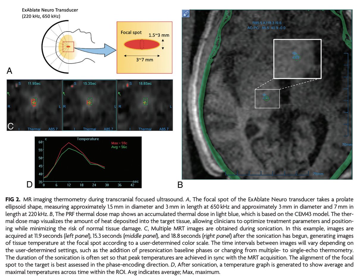 AJNR (@theajnr) on Twitter photo "MR Thermometry during Transcranial MR Imaging–Guided Focused Ultrasound Procedures: A Review"
<a href="/RaghavMattay/">Raghav Mattay</a> <a href="/DrKazNIR/">Kazim Narsinh</a>
doi.org/10.3174/ajnr.A…
#FellowsJournalClub #OpenAccess #MRGFUS "MR Thermometry during Transcranial MR Imaging–Guided Focused Ultrasound Procedures: A Review"
<a href="/RaghavMattay/">Raghav Mattay</a> <a href="/DrKazNIR/">Kazim Narsinh</a>
doi.org/10.3174/ajnr.A…
#FellowsJournalClub #OpenAccess #MRGFUS