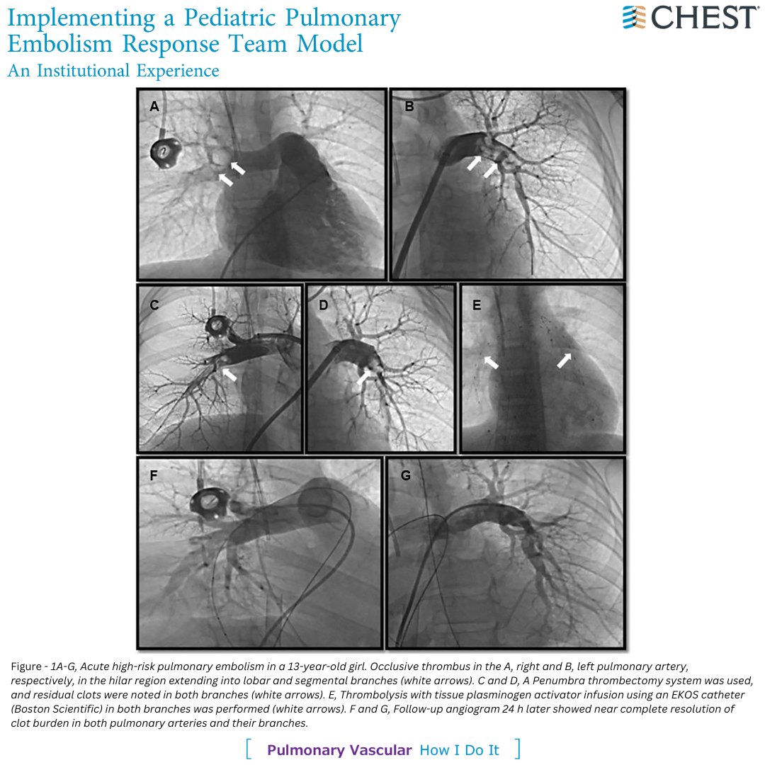 How I Do It: Bashir & colleagues describe the development & implementation of a pediatric pulmonary embolism response team designed to facilitate rapid, multidisciplinary, data-driven treatment decisions & management. Read the full @journal_CHEST article: hubs.la/Q02fGvkG0
