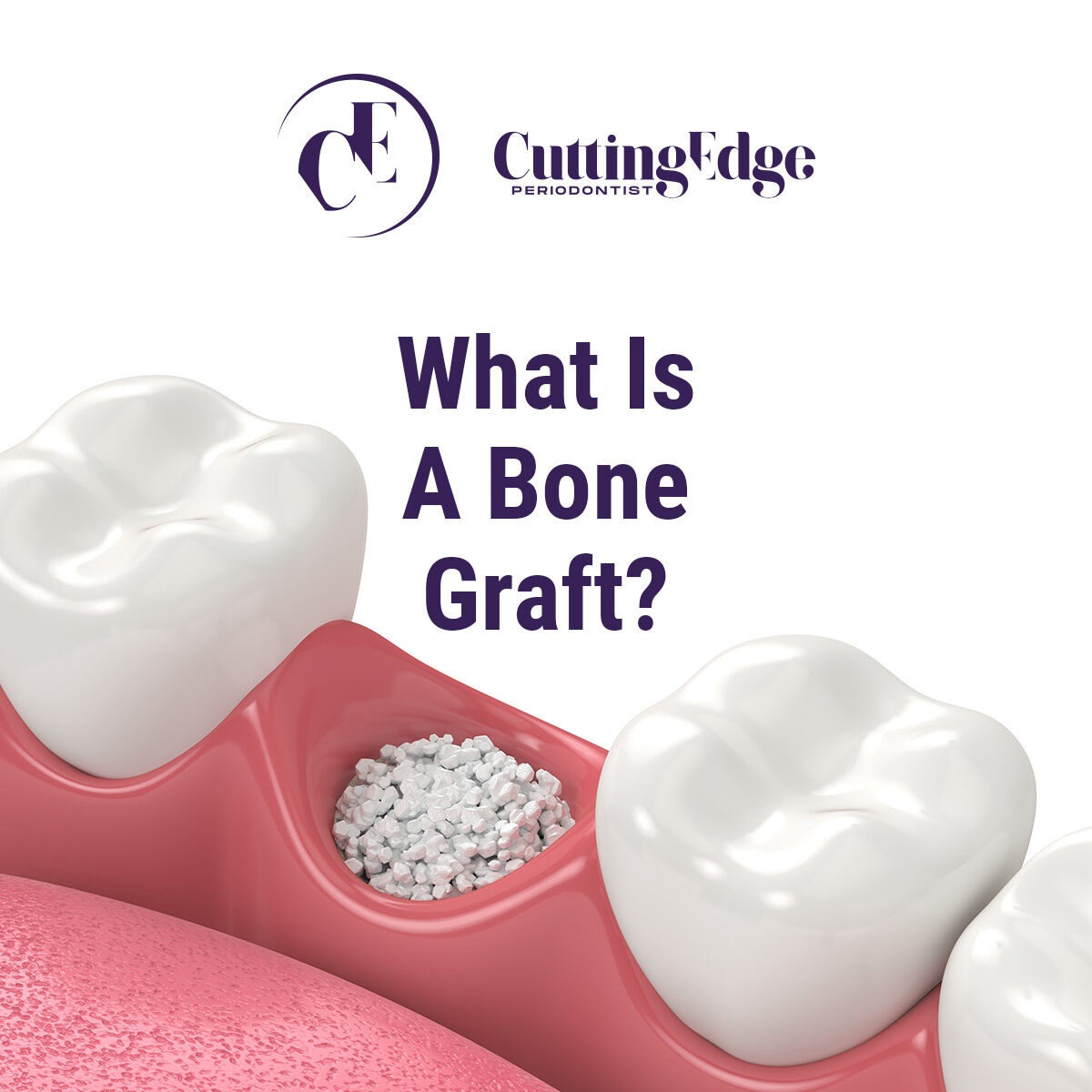 What is a Bone Graft? - bit.ly/3xy9bOF - #bonegraft #bonegrafting #dentalbonegraft #DrDianaSedler #CuttingEdgePeriodontist #Burbank #Glendale #periodontist #dentalimplants #allon4