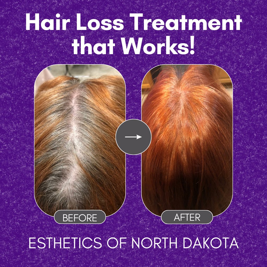estheticsofnd's tweet photo. Microchanneling stimulates and nourishes your hair follicles in order to prevent hair loss and increase hair regrowth! Contact us today for more information and to book your appointment! 💜 (701) 740-3280 #Skincare #ArmouredCosmetics  #GetSkinHealthy #EstheticsofNorthDakota https://t.co/wiOHEpCubx