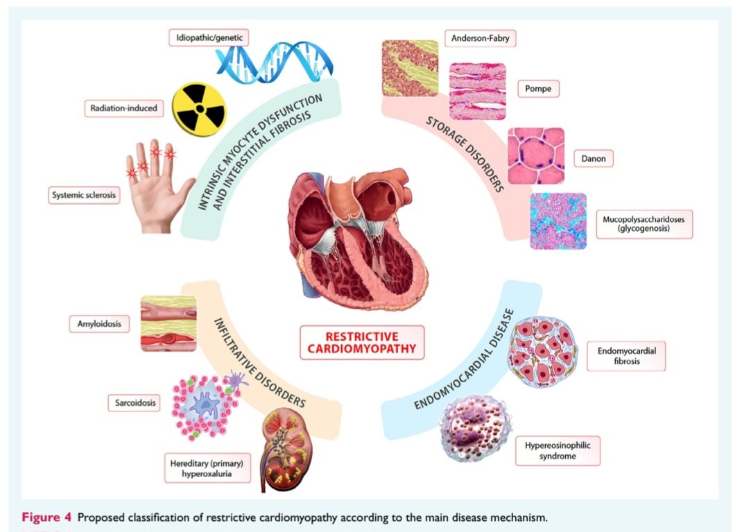 Manejo de las Miocardiopatías🫀
🔥State-Of-The-Art📄 <a href="/ESC_Journals/">European Society of Cardiology Journals</a>💯
🔴MCP representan un grupo de trastornos miocardicos heterogéneos caracterizados por diversas etiologías, múltiples mecanismos subyacentes y fenotipos.
🔴MCP dilatada, hipertrófica, restrictiva y arritmogénica⤵️