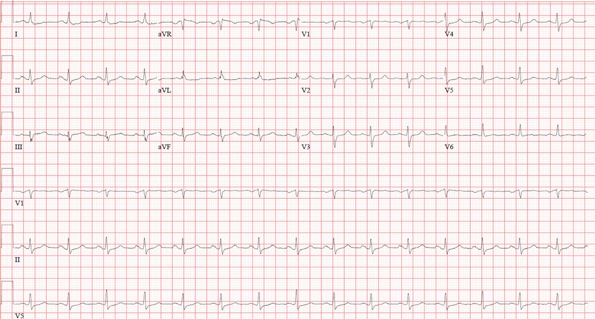 Matt Evans (@mevansmd) on Twitter photo What do you think of this EKG in the setting of chest pain? <a href="/smithECGBlog/">Stephen W. Smith</a> <a href="/PendellM/">Pendell Meyers</a> <a href="/EM_RESUS/">Sam Ghali, M.D.</a> What do you think of this EKG in the setting of chest pain? <a href="/smithECGBlog/">Stephen W. Smith</a> <a href="/PendellM/">Pendell Meyers</a> <a href="/EM_RESUS/">Sam Ghali, M.D.</a>