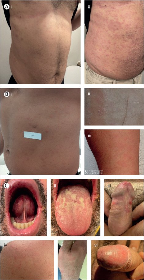Michael Marks (@dr_michaelmarks) on Twitter photo Led <a href="/oriolmitja/">Oriol Mitjà</a> our trial Linezolid for #Syphilis <a href="/TheLancetInfDis/">The Lancet Infectious Diseases</a> shorturl.at/fmrFL 600mg OD was NOT non-inferior to penicillin. Data underpins larger trial with 600mg BD. Excited to have UK sites participating. Thanks <a href="/drklausner/">drklausner</a> linked editorial shorturl.at/t0248 Led <a href="/oriolmitja/">Oriol Mitjà</a> our trial Linezolid for #Syphilis <a href="/TheLancetInfDis/">The Lancet Infectious Diseases</a> shorturl.at/fmrFL 600mg OD was NOT non-inferior to penicillin. Data underpins larger trial with 600mg BD. Excited to have UK sites participating. Thanks <a href="/drklausner/">drklausner</a> linked editorial shorturl.at/t0248