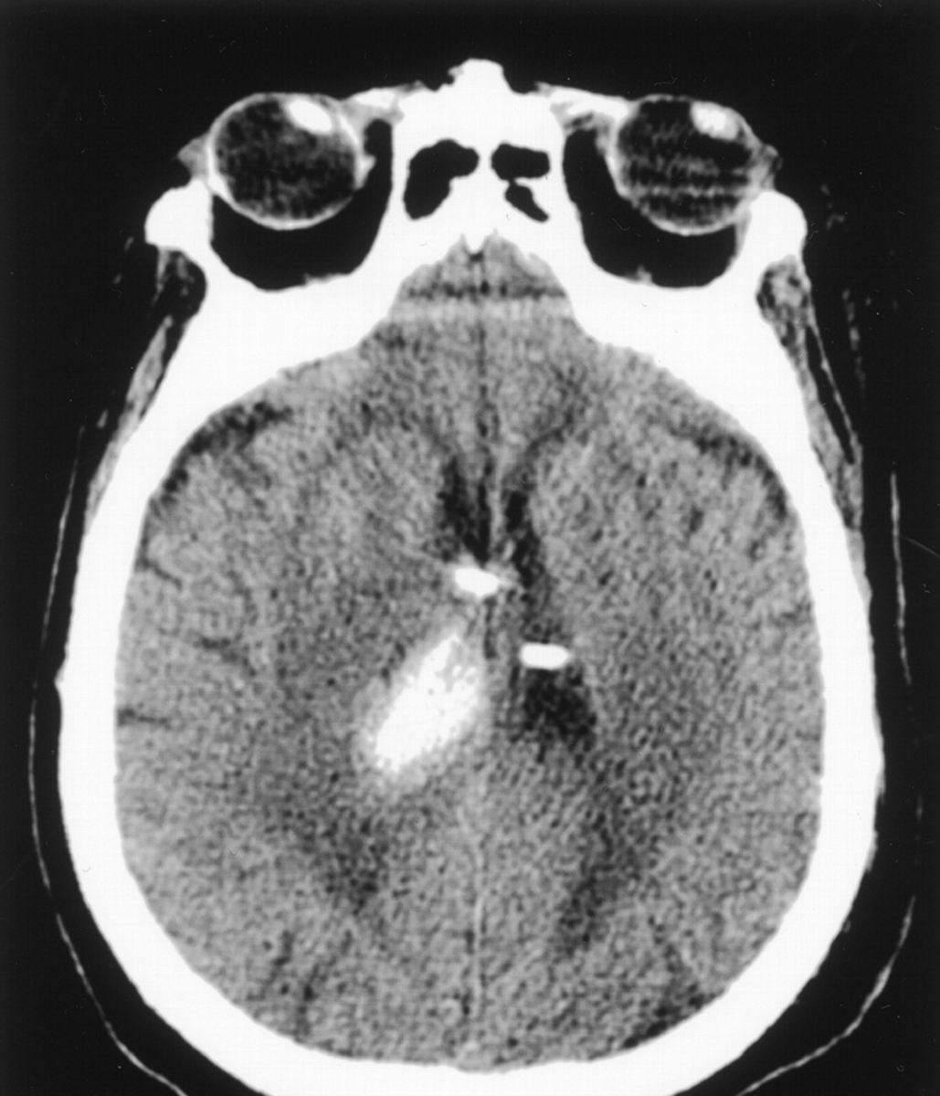 MedinaRiojaMD's tweet photo. Today's Clinical Pearl 🦪

"Wrong-way eyes" 👀

"Supratentorial stroke,  often causes conjugate gaze deviation toward the side of the lesion...however, thalamic lesions...can present with gaze deviation away from the side of the lesion." 🚨🤓

#Neuro 
   #Neurotwitter 

1/2 https://t.co/L1eyZkk1Bf