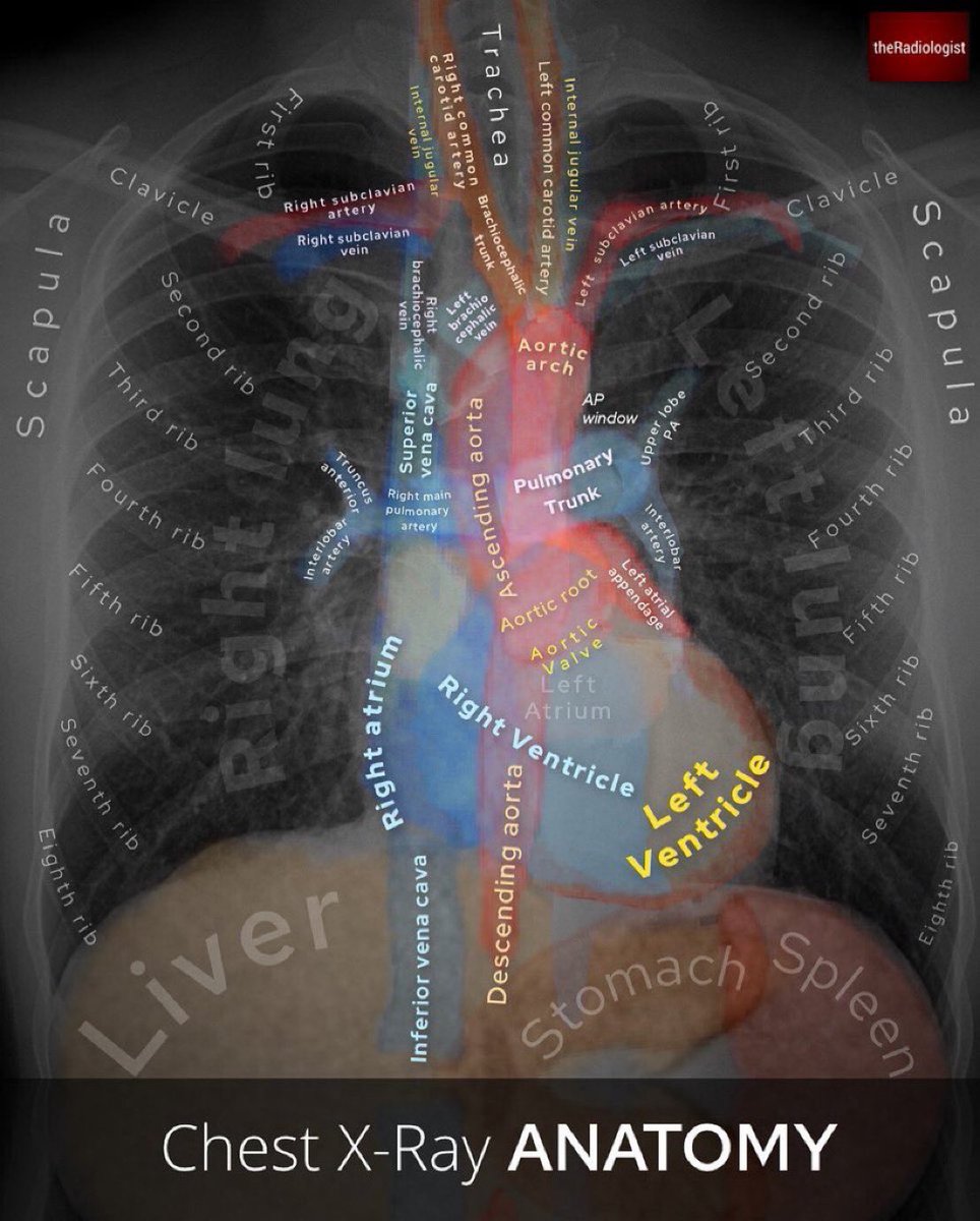 BrownJHM's tweet photo. Chest X-Ray fused with images of a coronal CT demonstrating mediastinal anatomy @radiologistpage https://t.co/3neJAhn4SP