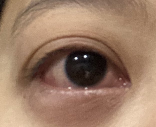 อาการโควิคสายพันธุใหม่มีไข้สูง หวัดคัดจมูก ไอ ผื่นคัน ปวดศีรษะ ปวดตาม จมูกไม่ได้กลิ่น อาจมีอาการท้องเสียร่วมด้วย เยื่อบุตาอักเสบ คล้ายตาแดง คันตา ขี้ตาเหนียว ลืมเปลือกตาไม่ขึ้น /ไอร์มีอาการหัวใจเต้นเร็วร่วมด้วย เหนื่อยมากค่ะขาไม่มีแรง ปวดตามข้อ