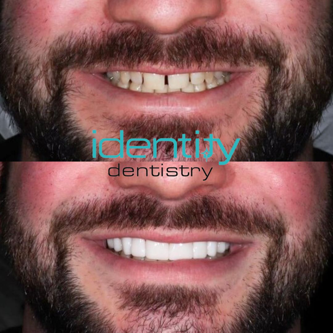 We love what we do 💜🦷

For bookings and/or more info:
🌐identitydentistry.com.au
📞(02) 6248 5692

#IdentityDentistry #MakingSmiles #TopDentist #BeautifulTeeth