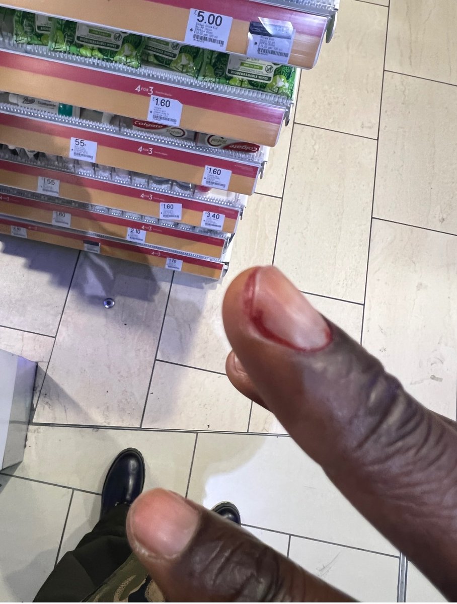 abs902102002's tweet photo. @chronomentary Injury caused by your PCR test https://t.co/dPAqaKyUIp