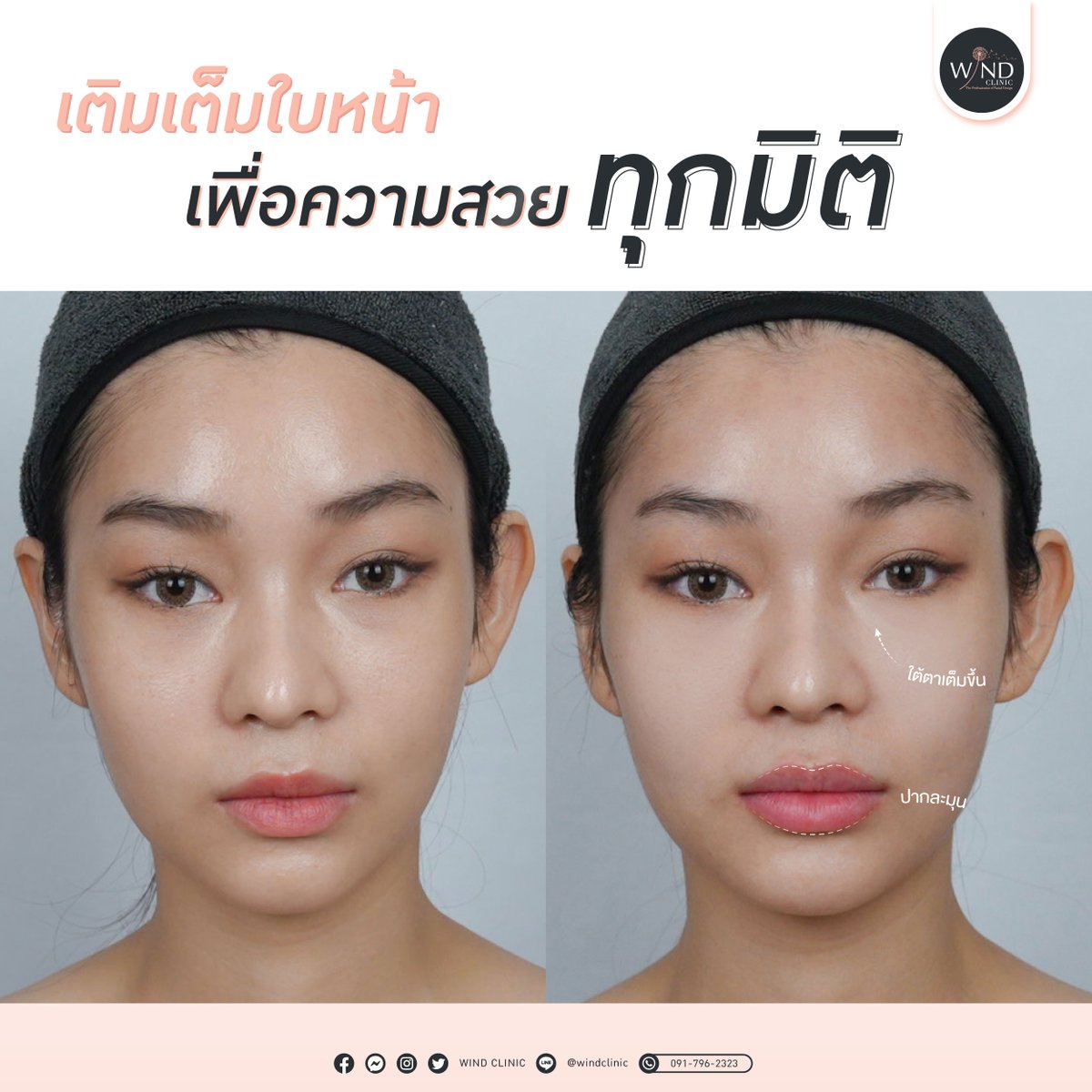 windclinic's tweet photo. ปรับลุคเพิ่มความหวาน ความละมุน ดูเป็นธรรมชาติ
เพิ่มมิติใบหน้าให้สวยธรรมชาติแบบที่ต้องการ

การใช้ฟิลเลอร์ในการปรับรูปหน้าอย่างเข้าใจ
ของคุณหมอบาส ก็ทำให้ใบหน้าดูมีมิติขึ้น ถูกใจกับผลลัพธ์ในการรักษา
#ปรับรูปหน้า #มืออาชีพตัวจริง #ยกกระชับ
#JuvedermVolite #juvederm #WINDClinic https://t.co/IoipoO3ZoN
