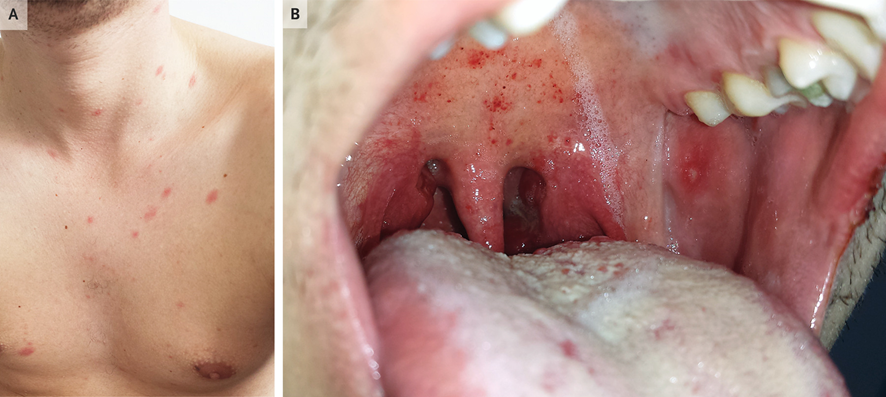 guerreroespejo's tweet photo. A 26-y-o♂️, #condomless #sex with a new partner 2 wk before: scattered, erythematous papules &amp; macules (A), fevers, chills, sore throat, palatal petechiae, buccal ulcerations, &amp; pharyngeal erythema (B)

Leukopenia, lymphopenia, thrombocytopenia
1/3

DOI: 10.1056/NEJMicm2306536 https://t.co/sapE0giqJ1