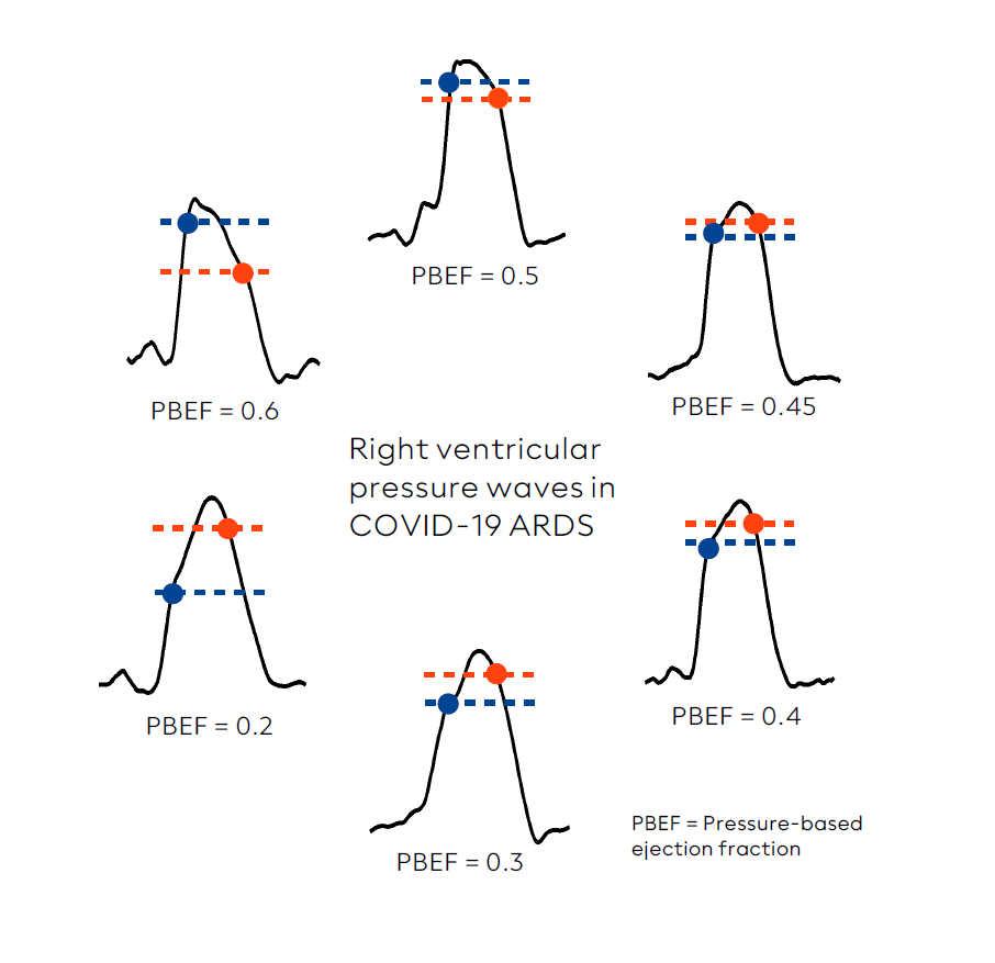 emkamedical's tweet photo. Right ventricular pressure curves in COVID-19 Pneumonia/ARDS measured with CorLog
#hemodynamics #rightventricle https://t.co/Q21V374i6S