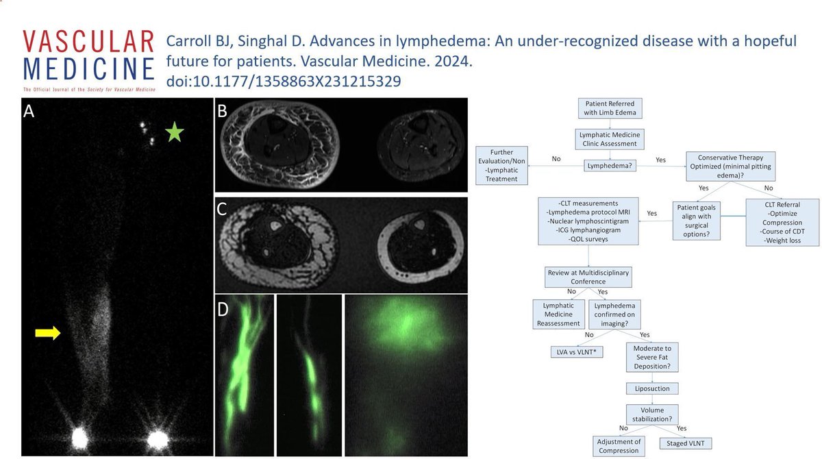 VascularMedicine (@vmj_svm) on Twitter photo Online First! The newest article in our Core Curriculum in Vascular Medicine collection – ‘Advances in Lymphedema: An under-recognized disease with a hopeful future for patients’ by Dr. Brett Carroll and <a href="/DrDhruvSinghal/">Dr. Dhruv Singhal</a>.
buff.ly/3SbWiF1
#VascularTwitter Online First! The newest article in our Core Curriculum in Vascular Medicine collection – ‘Advances in Lymphedema: An under-recognized disease with a hopeful future for patients’ by Dr. Brett Carroll and <a href="/DrDhruvSinghal/">Dr. Dhruv Singhal</a>.
buff.ly/3SbWiF1
#VascularTwitter