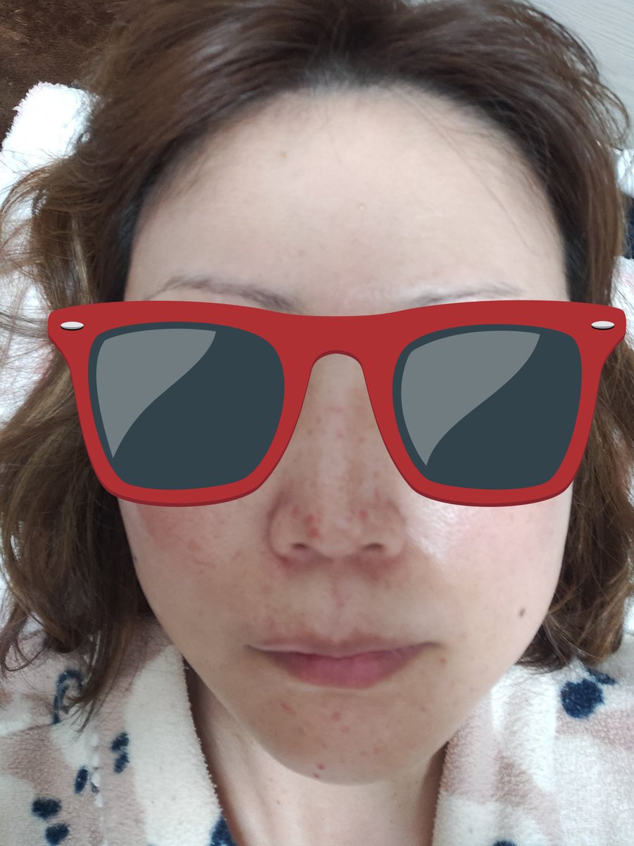 uribho_'s tweet photo. シミ取りレーザー15日目と20日目の写真
かなり赤みが薄くなってきたけどこわい💧
朝、CBD→���トプラセンタ→グライコ→保湿系
夜、CBD→ヒトプラセンタ→ハイドロキノン→保湿系

#CBD
 #トレチノイン
 #ハイドロキノン
 #シミ取りレーザー
 #ゲンタシン軟膏
 #大曽根皮膚科
 #グライコ https://t.co/lI5wcFiE7G