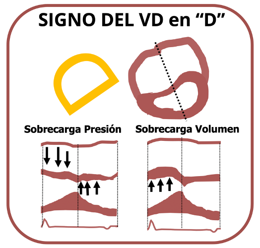 MAecocardio's tweet photo. SIGNOS ECOCARDIOGRAFICOS #EcoSignos 
📢 Signo del VD en D, aplanamiento septal:
📌Sobrecarga de Volumen:Movimiento anterior sistólico del septo-Septo aplanado en diástole.
📌Sobrecarga de Presión: Desplazamiento septal desde la telediástole ,es mayor al final de la sístole. https://t.co/Su9iFOe4yQ