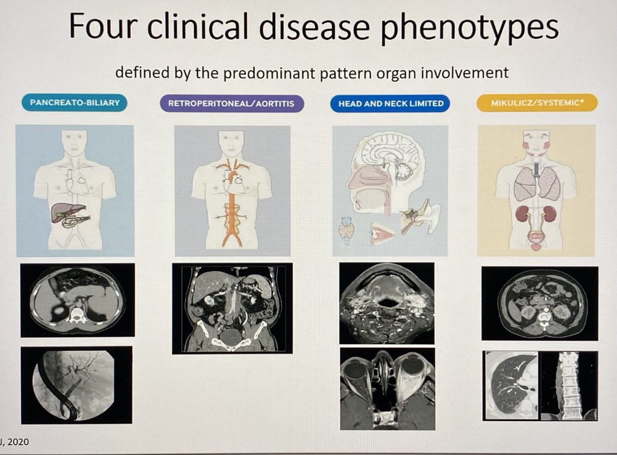 LastManStand85's tweet image. The 4 clinical disease phenotypes of IgG4-Related Disease &amp;amp; The 2020 Diagnostic Criteria👇
#MedTwitter #Rheumatology #IgG4
