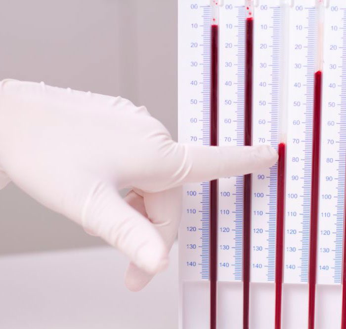 ie_1q's tweet photo. اهم المعلومات الي تحتاج تعرفها  عن تحليل 🩸(ESR TEST ) https://t.co/qzIphUR6AM