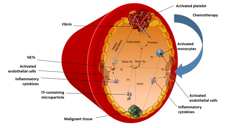cardiomet_CE's tweet photo. 5) Evidence ➡️cancer itself is associated with a state of #hypercoagulability, driven by release of #procoagulant factors e.g. tissue factor #TF, from malignant tissue, &amp; by inflammation-driven activation of endothelial cells, #platelets, &amp; #leukocytes
https://t.co/JILJlVIzHS https://t.co/1hJ4jQ9Ke2